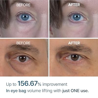 Eyephalt Eye Cream